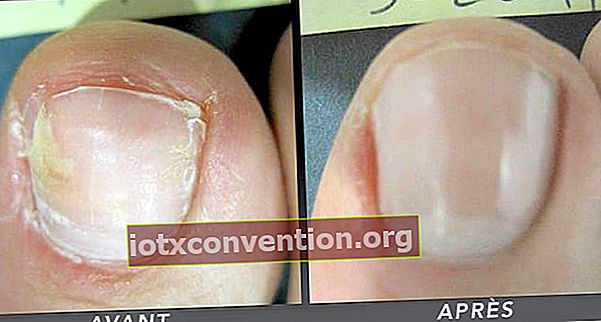 前後の足指の爪の真菌症