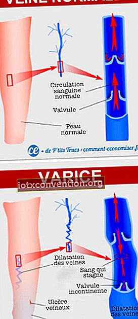 Confronto tra vene normali e vene varicose