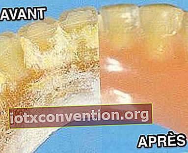 Gigi palsu sebelum dan selepas pembersihan bikarbonat