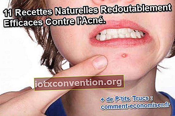 11 ricette naturali per l'acne
