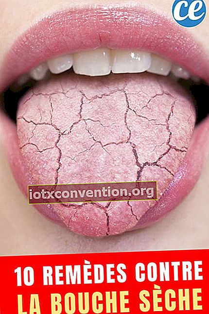 Mulut close-up menjulurkan lidah kering dengan teks: 10 pengobatan untuk mulut kering