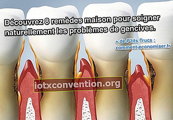 8 natürliche und wirksame Heilmittel gegen Zahnfleischprobleme