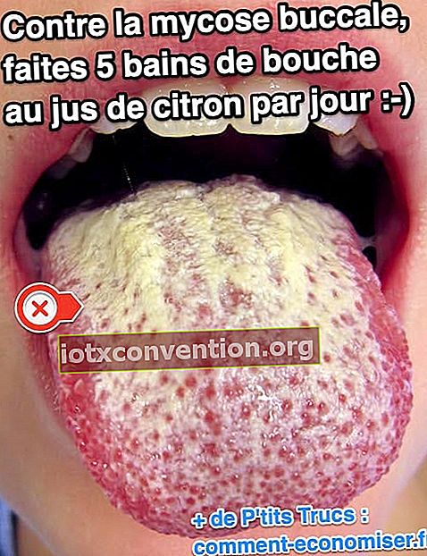 Citronsaftläkemedlet för oral jästinfektion