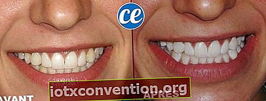 歯を白くするための在宅治療の結果